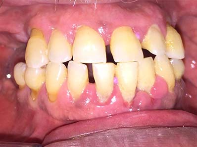 all-in-four denti