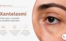 Xantelasmi sulle palpebre: cosa sono e quando è possibile asportarli