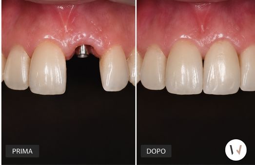 Prima e dopo impianto dentale Prima e dopo di un trattamento di implantologia a Bergamo con impianto dentale