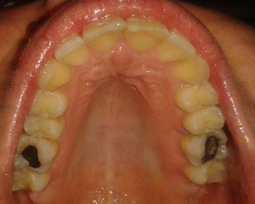 Risultato dopo trattamento di ortodonzia a Bergamo