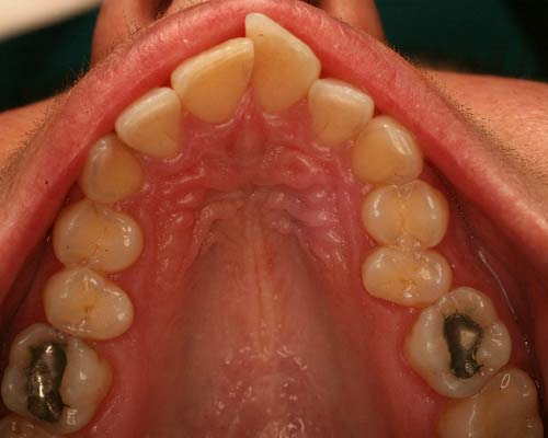 Ortodonzia Bergamo – situazione prima del trattamento ortodontico